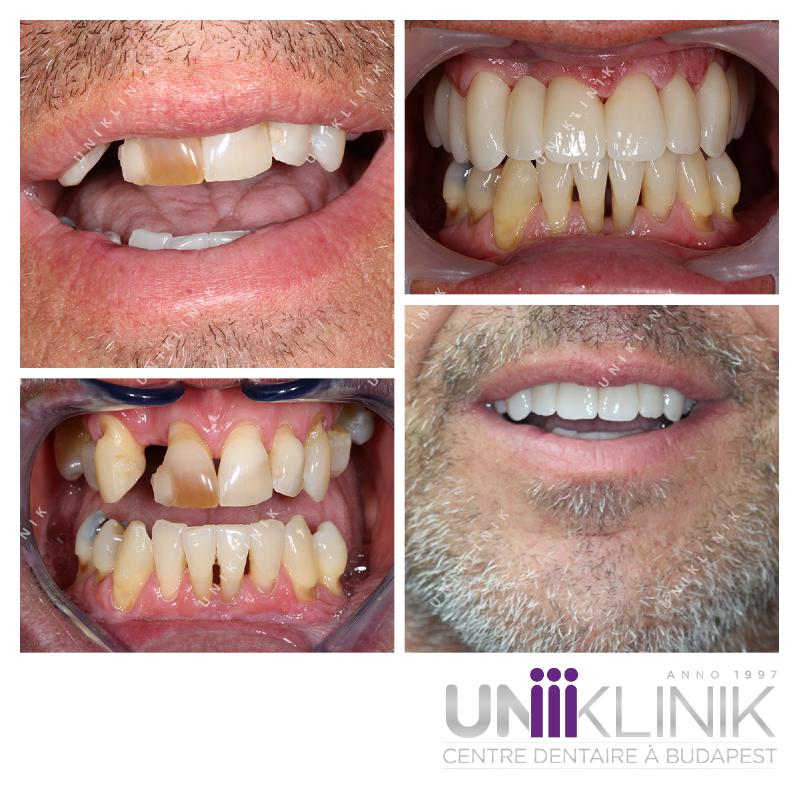 Couronne Monolithique En Zircone ou Full-zircone Sur Dent Couronne Monolithique En Zircone ou Full-zircone Sur Dent