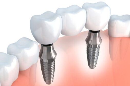 Implant Dentaire Hongrie Implant Bridge Implant Dentaire Hongrie Implant Bridge