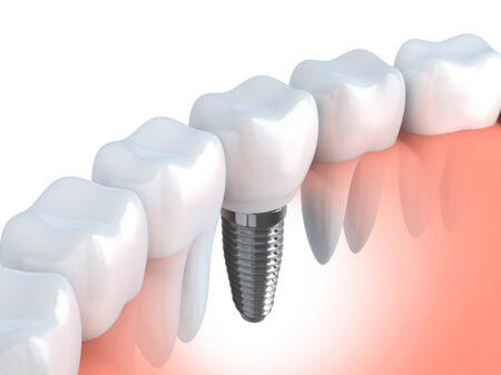 Implant Dentaire Hongrie Pose Implant Implant Dentaire Hongrie Pose Implant
