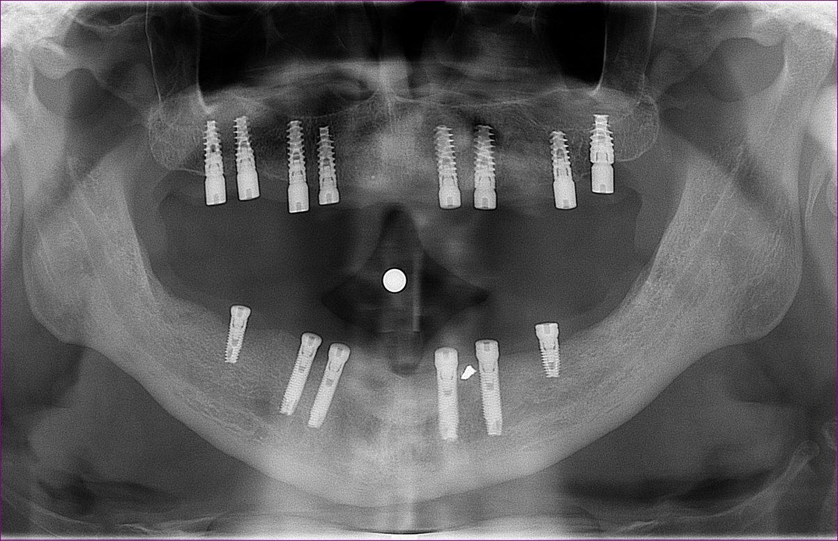 implants-dentaires-protheses-transvisses