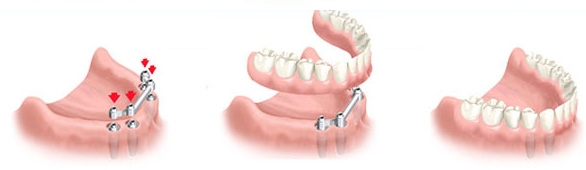 Prothèses Dentaires Temporaires,Dentier Provisoire,Couvre Dents,Fau