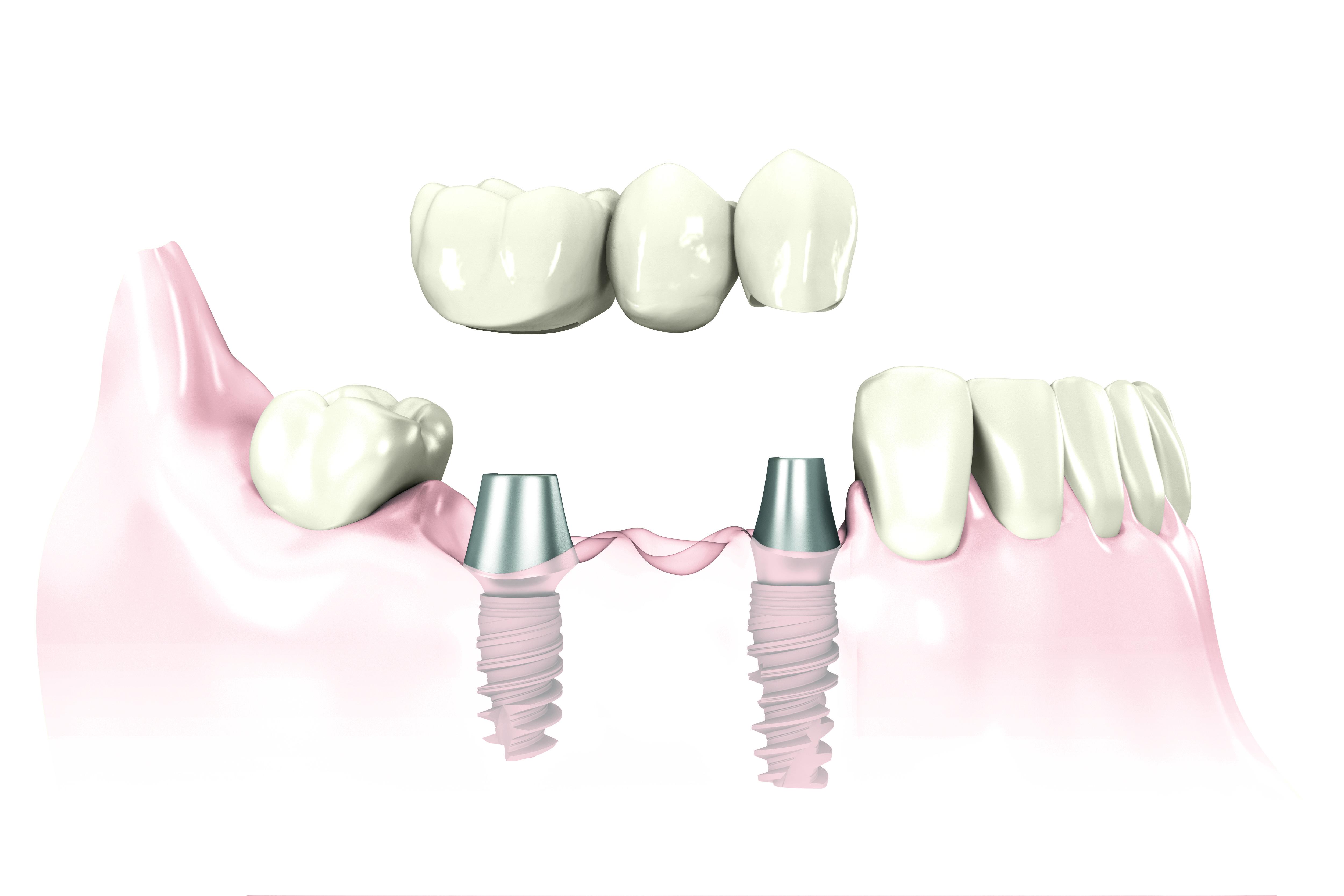 Bridge-sur-implant-dentaire.JPG#asset:35527