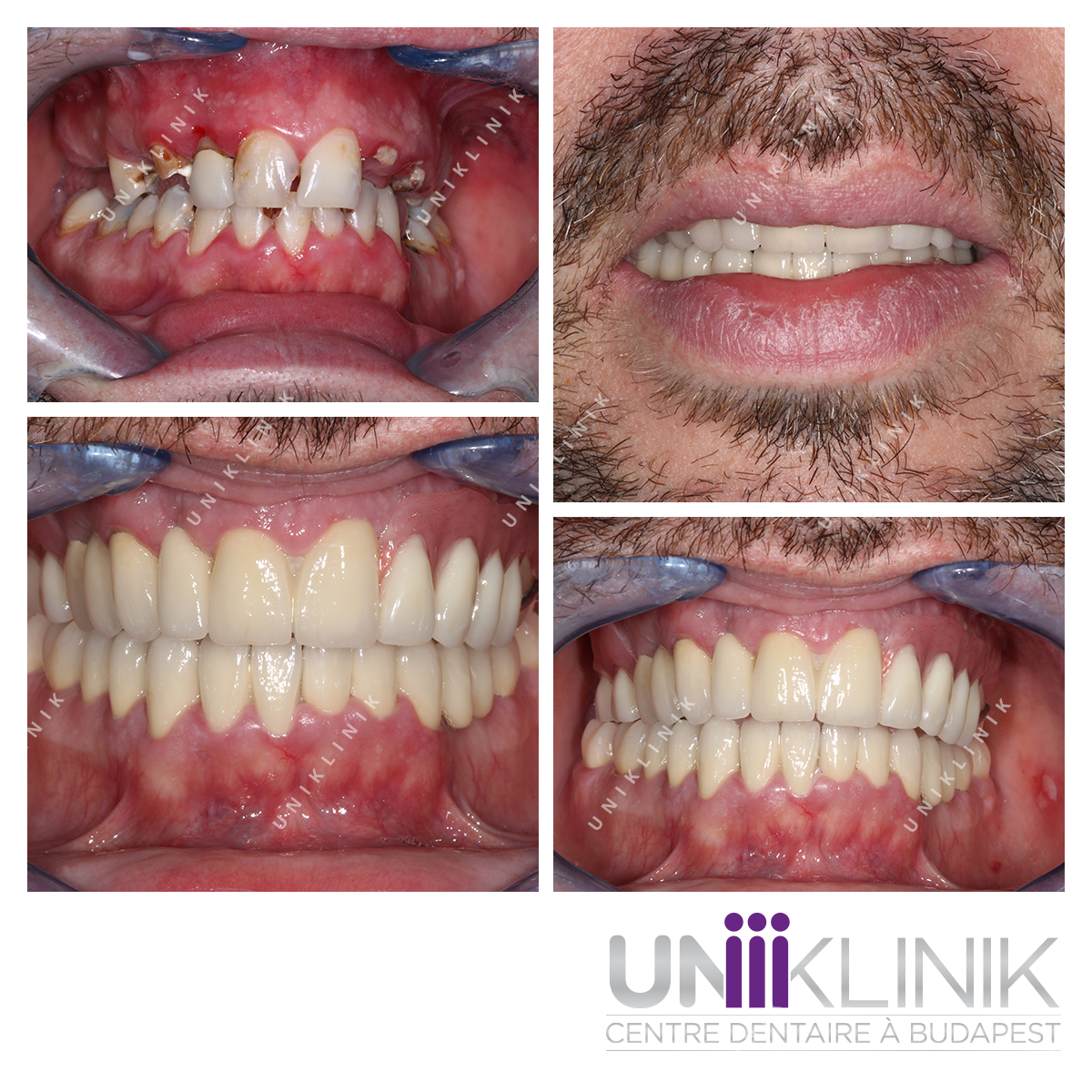 Photo Dentaire Avan Apres Attachement De Précision Dentiste Hongrie