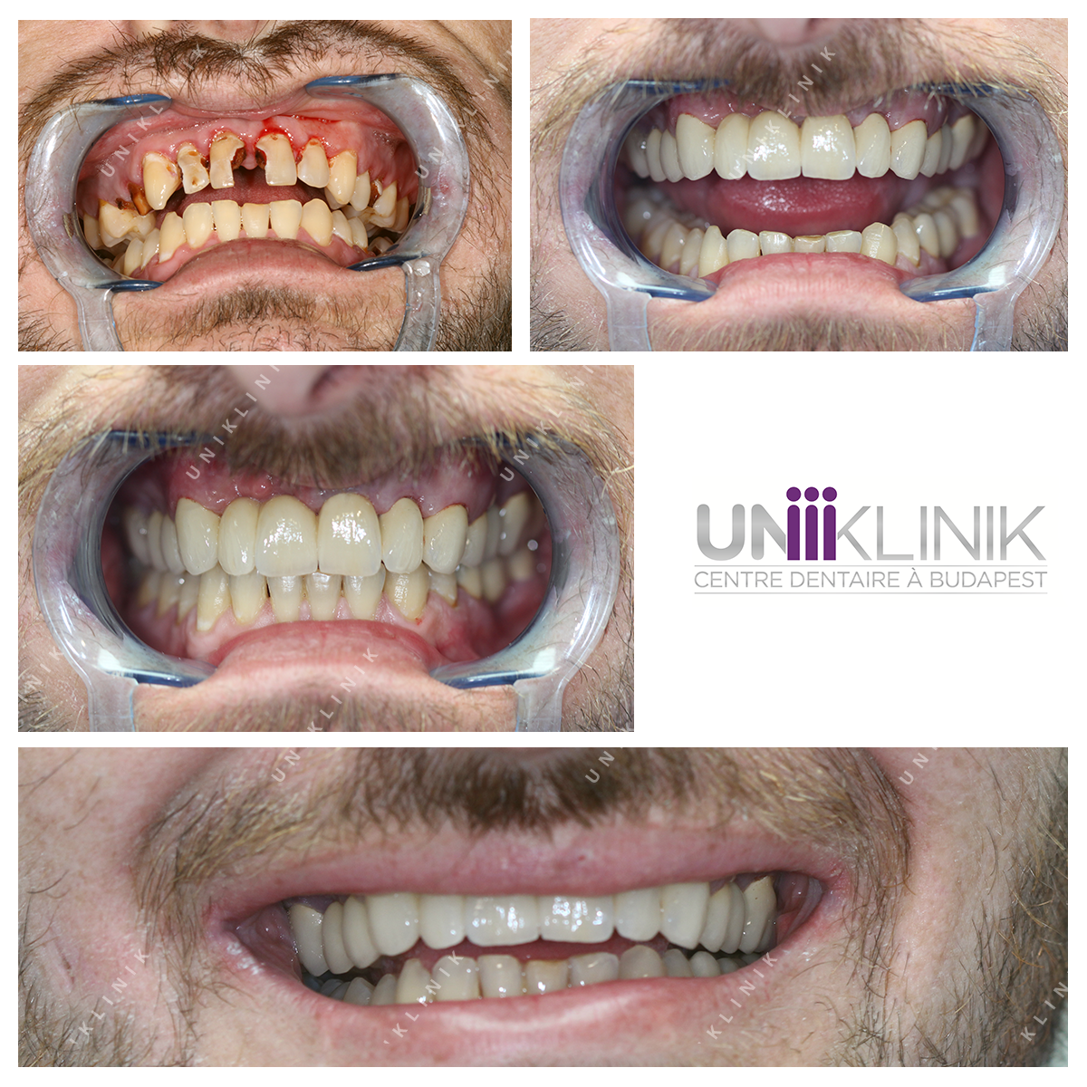 Photo Dent Avant Apres Soins Dentaire Couronne Céramo Métallique Dentiste Hongrie