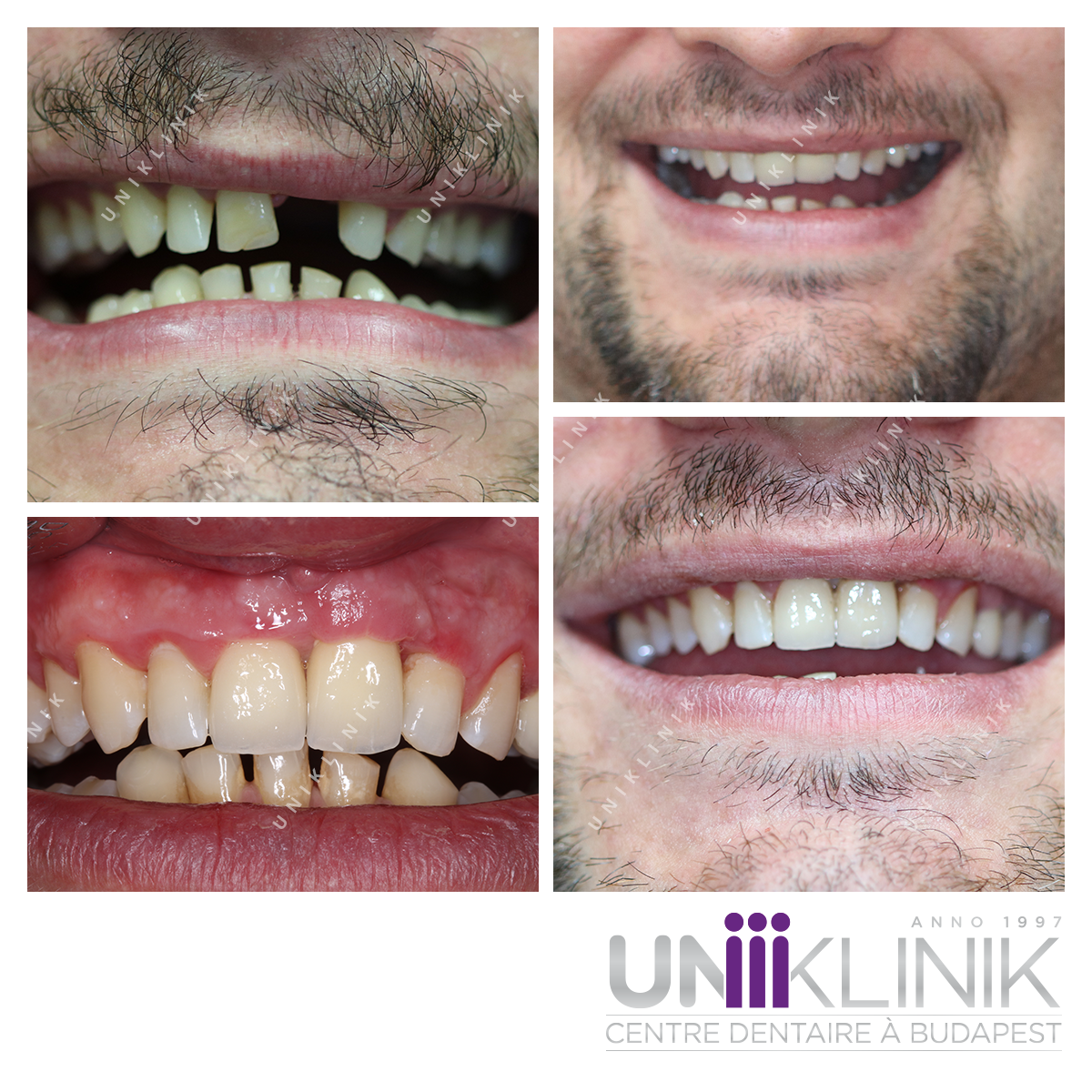 Remplacement D Une Dent De Devant Par Implant Dentaire