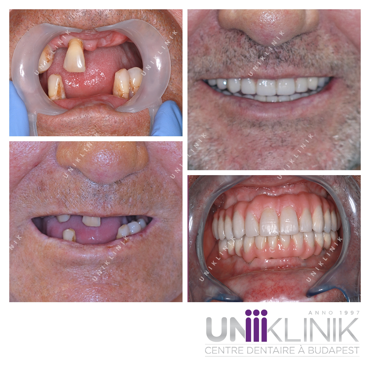 Réhabilitation Complète Implant Dentaire Mis En Charge Immédiate Dentiste Hongrie