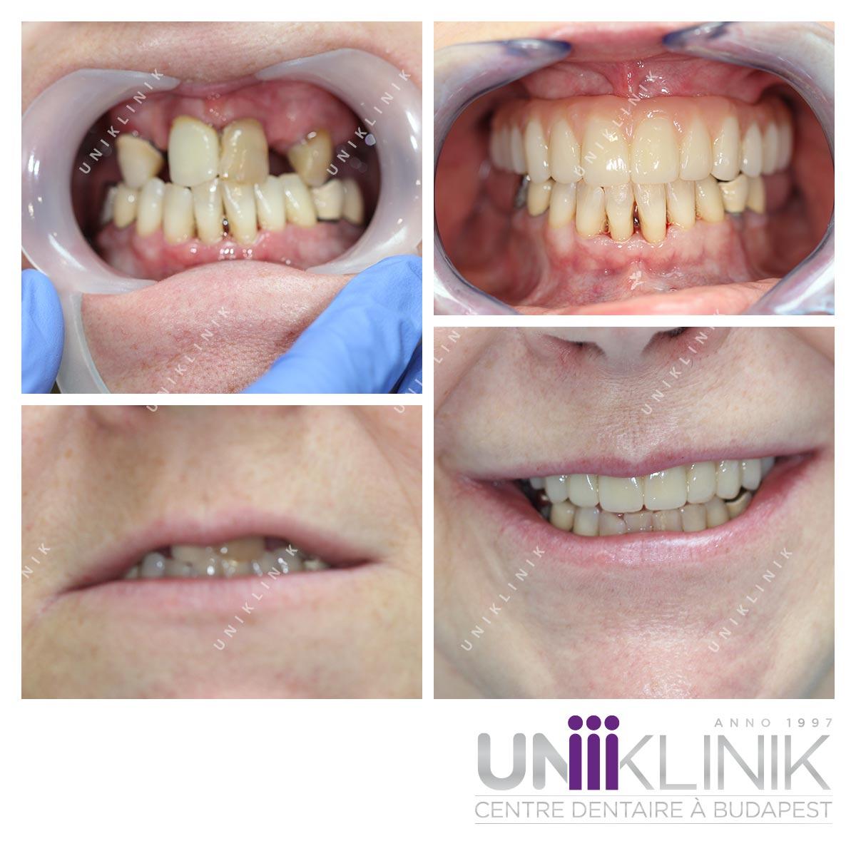 Soins Dentaires Bridge Sur Implants Photo
