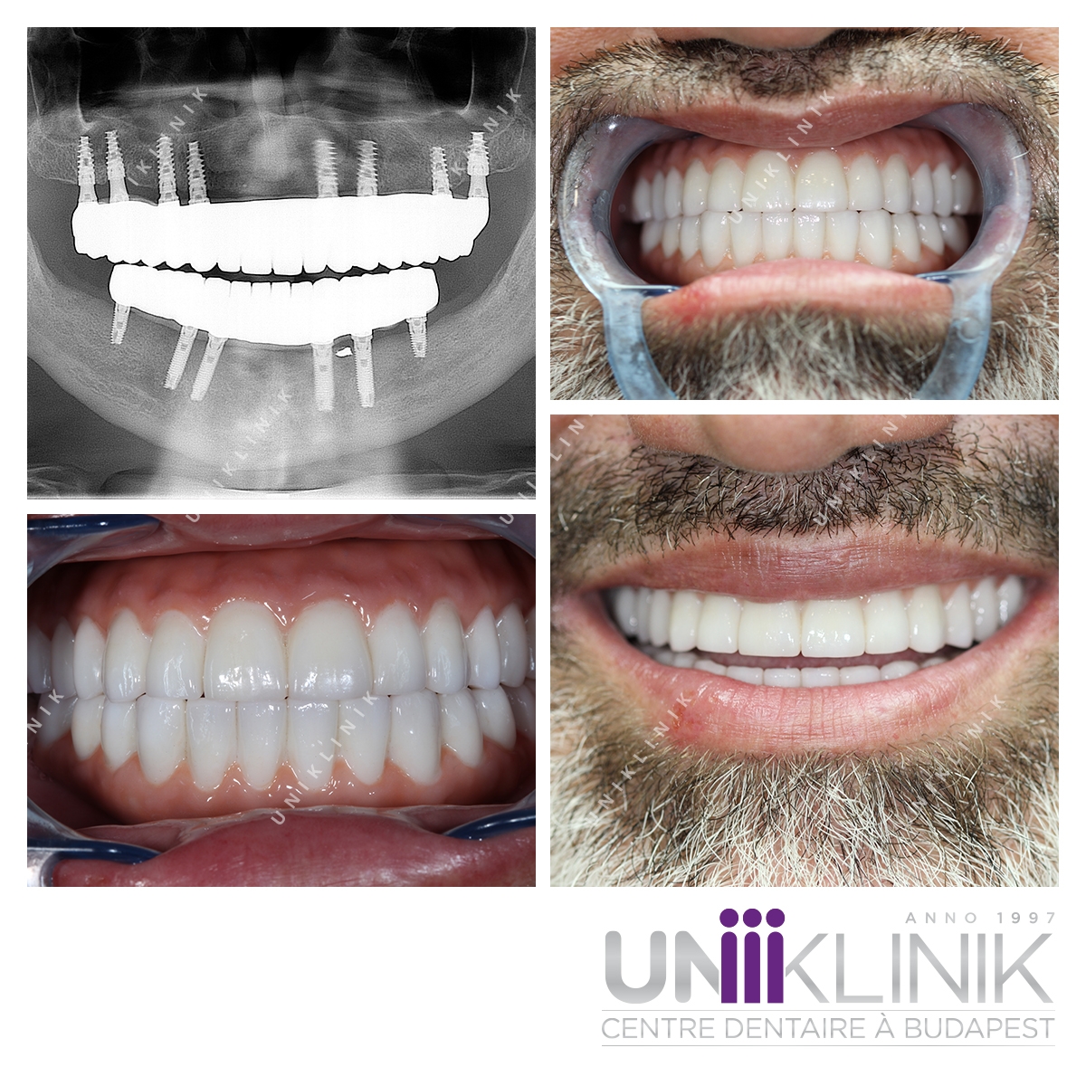 Solution All On Zircone Monolithique