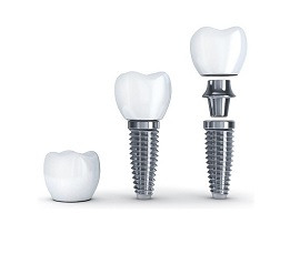 Avantage Des Implants Dentaires