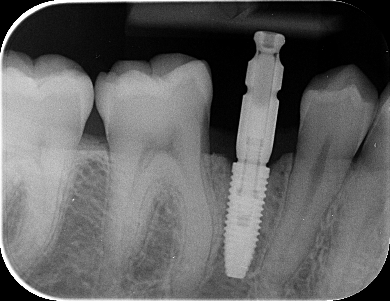 Implant dentaire Nobel Biocare avec son pilier d'empreinte sur une radio locale