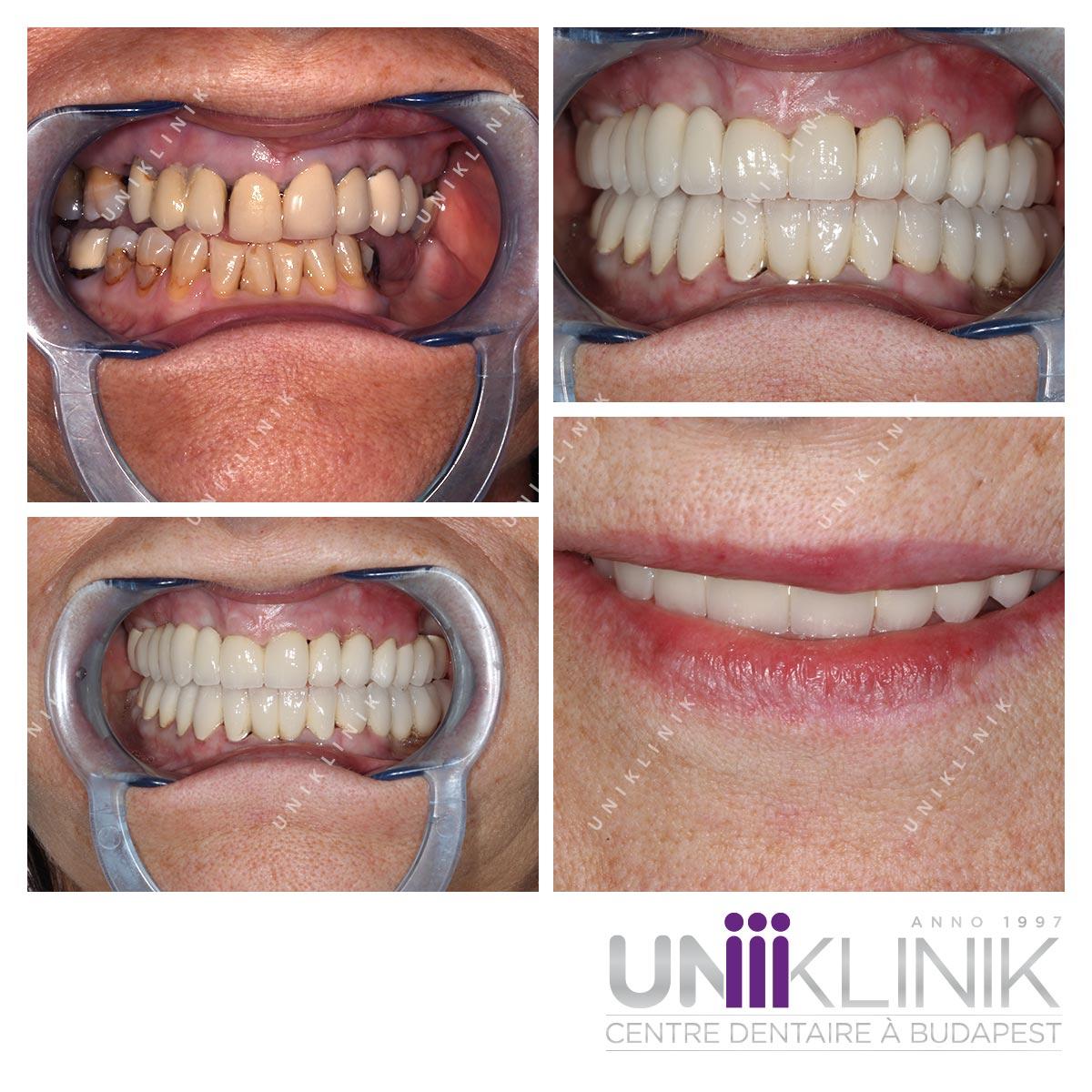 Photo Dentaire Avant Apres Couronne Ceramo Metallique Dentiste Hongrie 1