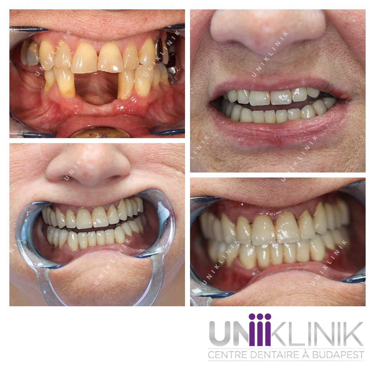 Photo Dentaire Avant Apres Couronne Ceramo Metallique Dentiste Hongrie 2