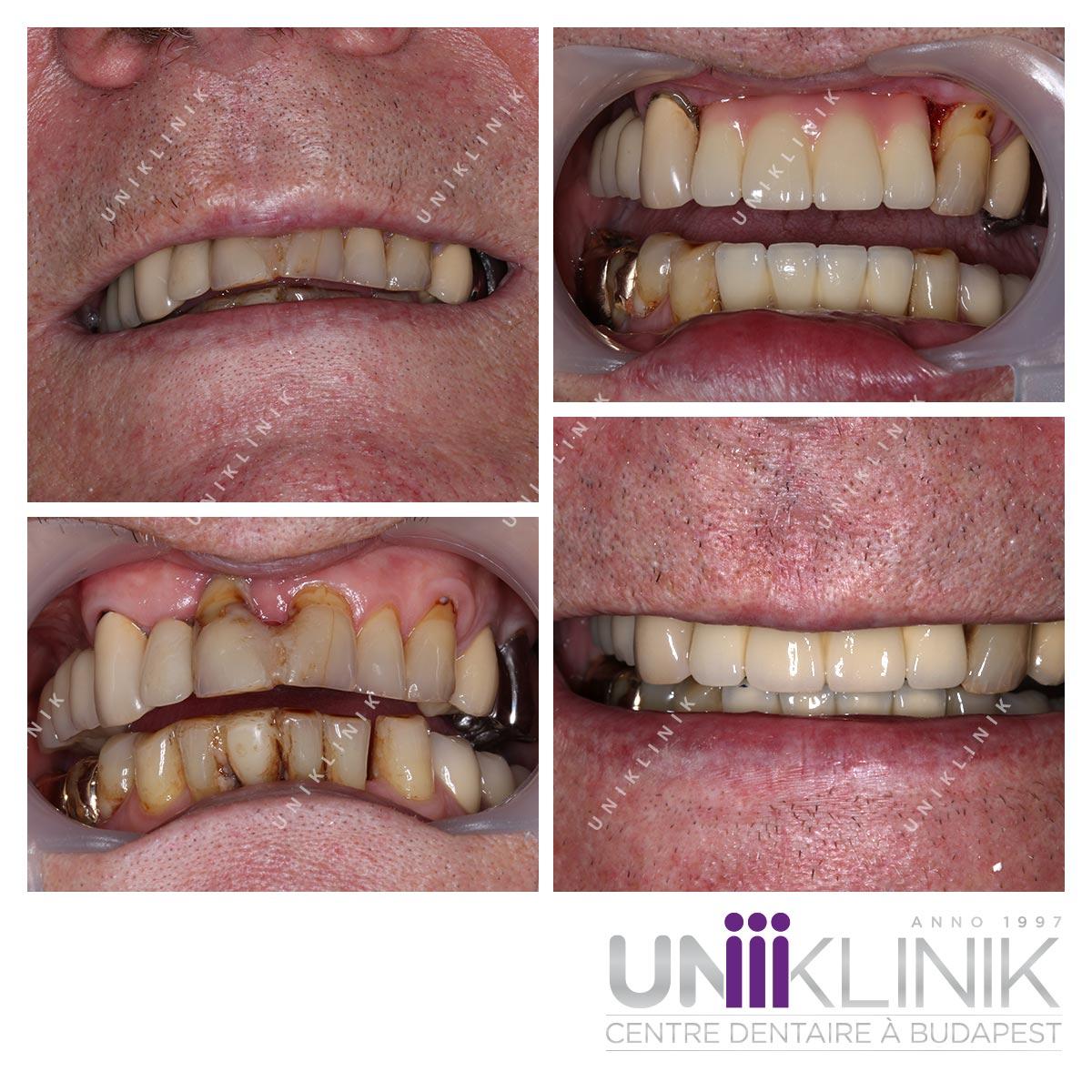 Photo Dentaire Avant Apres Couronne Ceramo Metallique Dentiste Hongrie 5