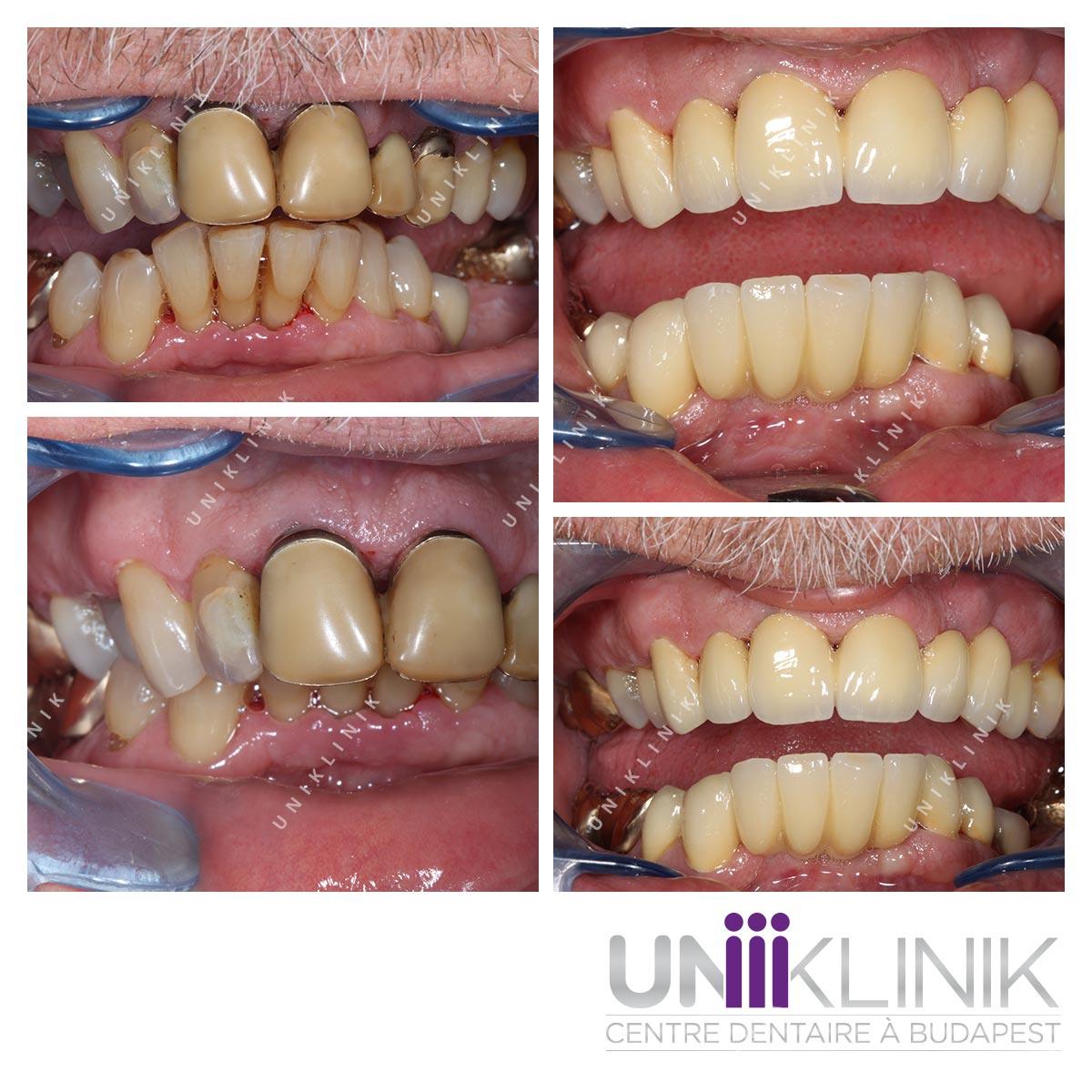 Photo Dentaire Avant Apres Couronne Ceramo Metallique Dentiste Hongrie 6