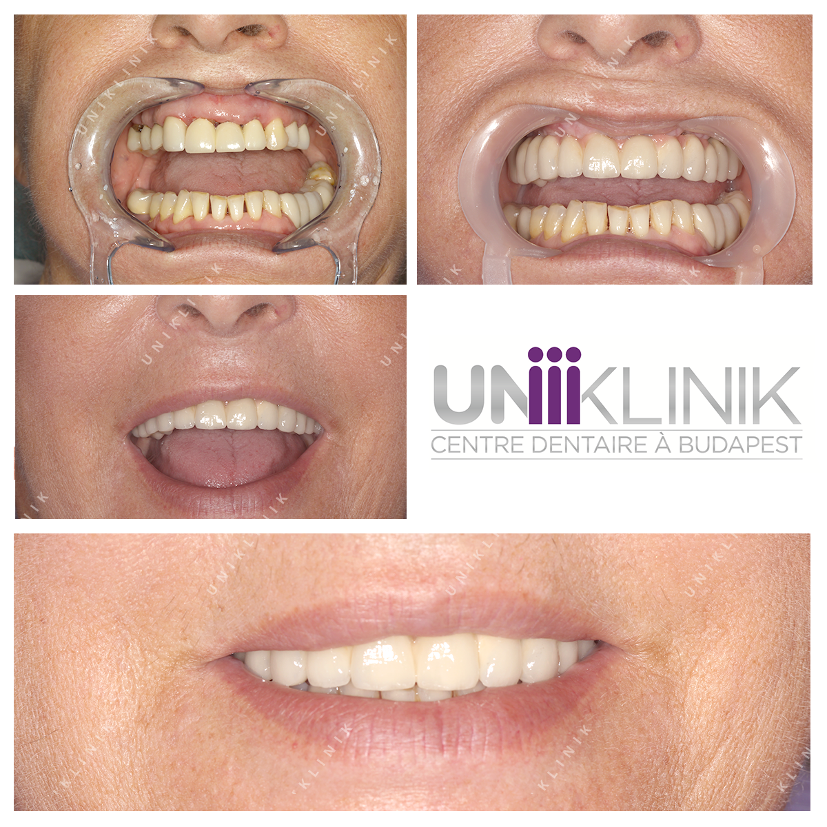 Photo Dentaire Avant Apres Couronne Ceramo Metallique Sur Implants Dentaire Dentiste Hongrie 1