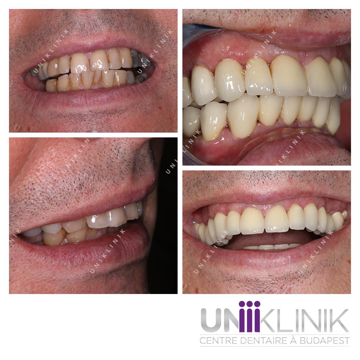 Photo Dentaire Avant Apres Couronne Esthetique Dentiste Hongrie 2