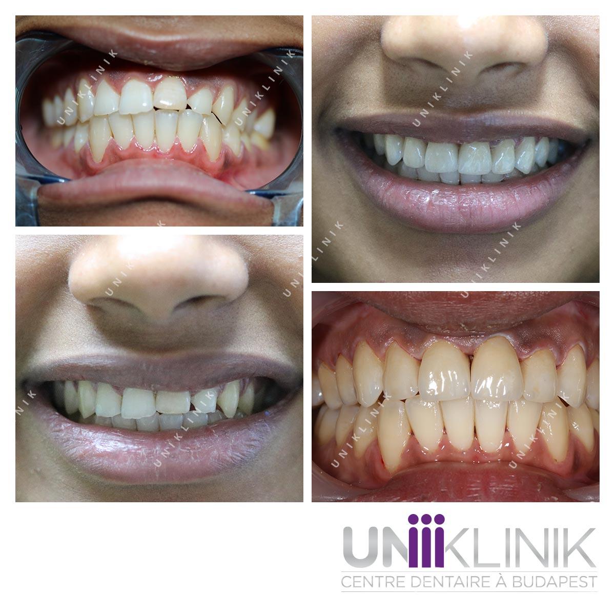 Photo Dentaire Avant Apres Couronne Esthetique Dentiste Hongrie 4