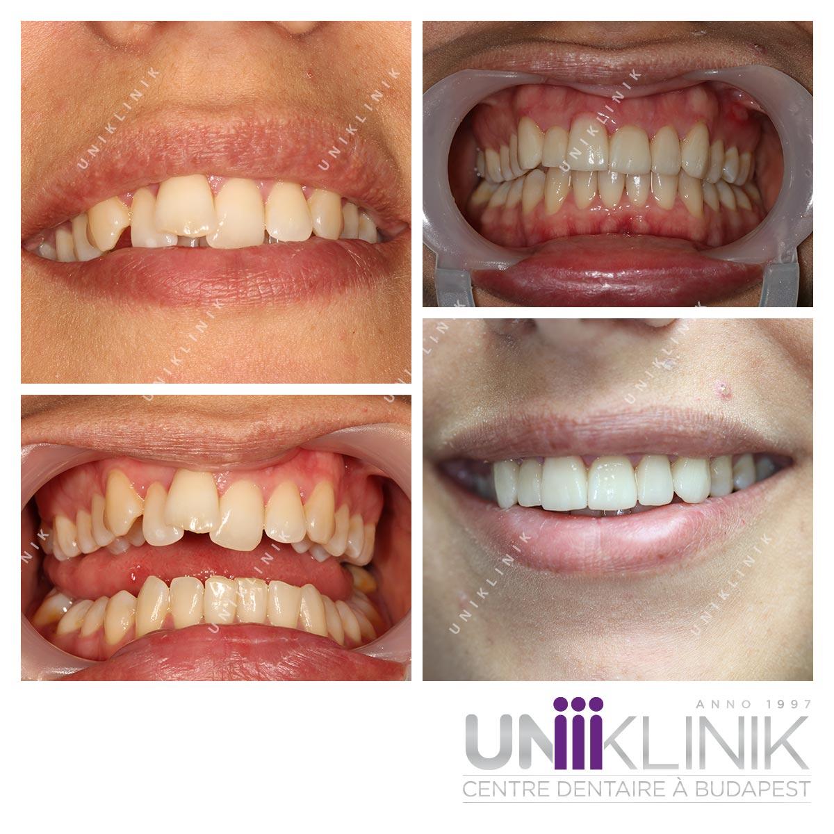 Photo Dentaire Avant Apres Couronne Esthetique Dentiste Hongrie 6