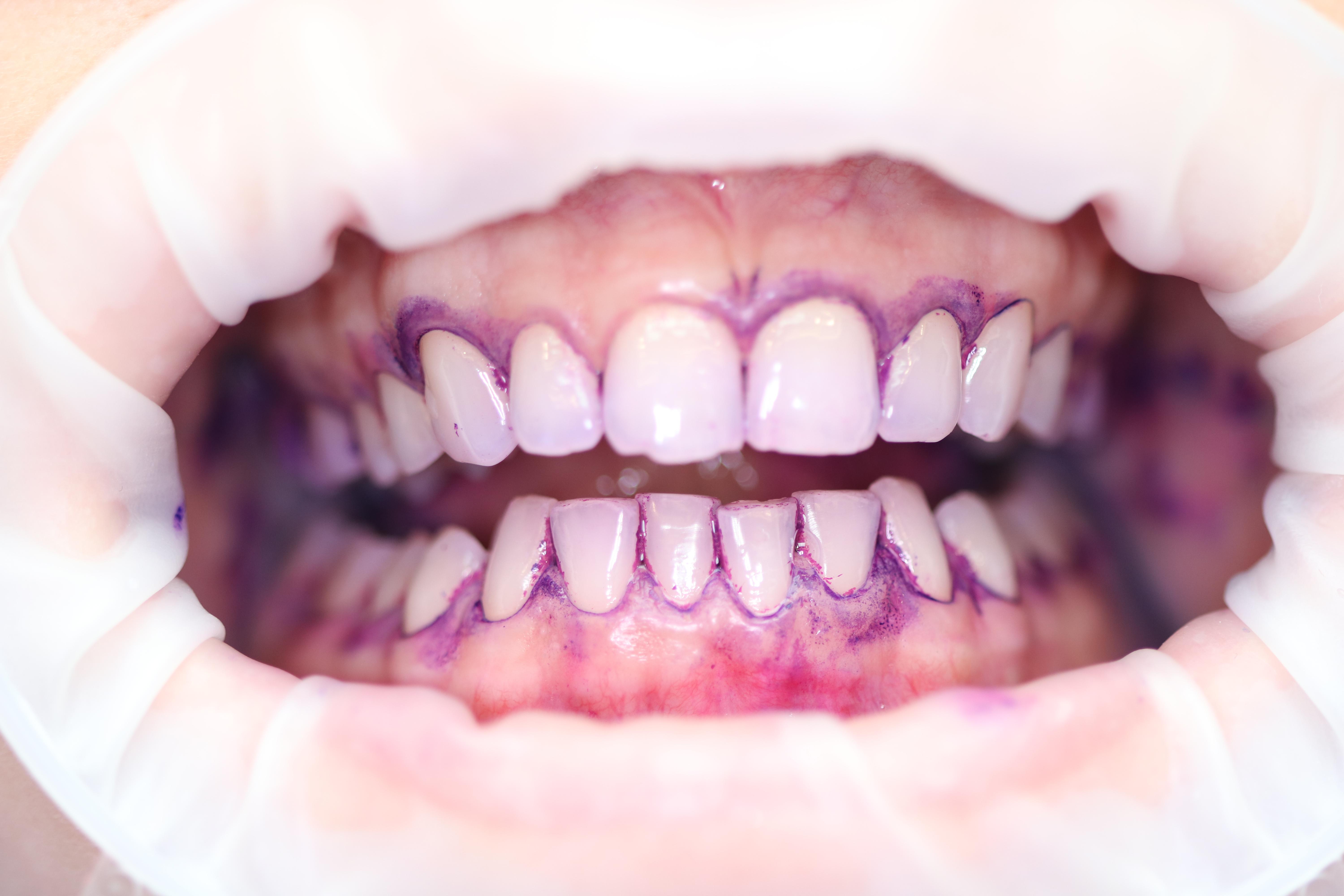 traitement_biofilm_guidé_Dentiste_Budapest.JPG#asset:35570