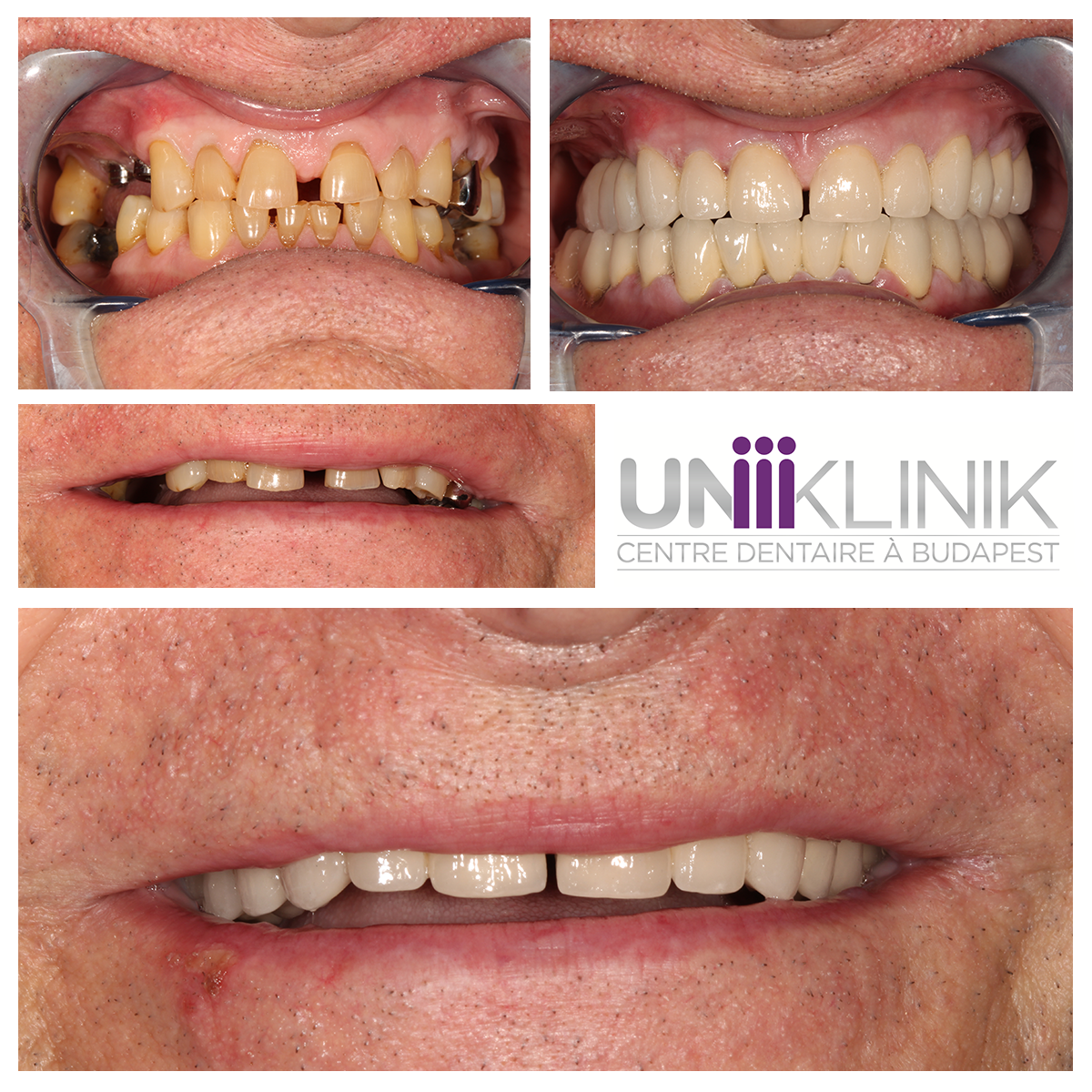 Réhabilitation Complète Avec Couronnes Céramo Métalliques Dentiste Hongrie