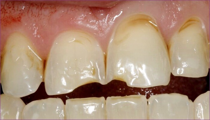 Érosion Acide La Mort Lente Des Dents