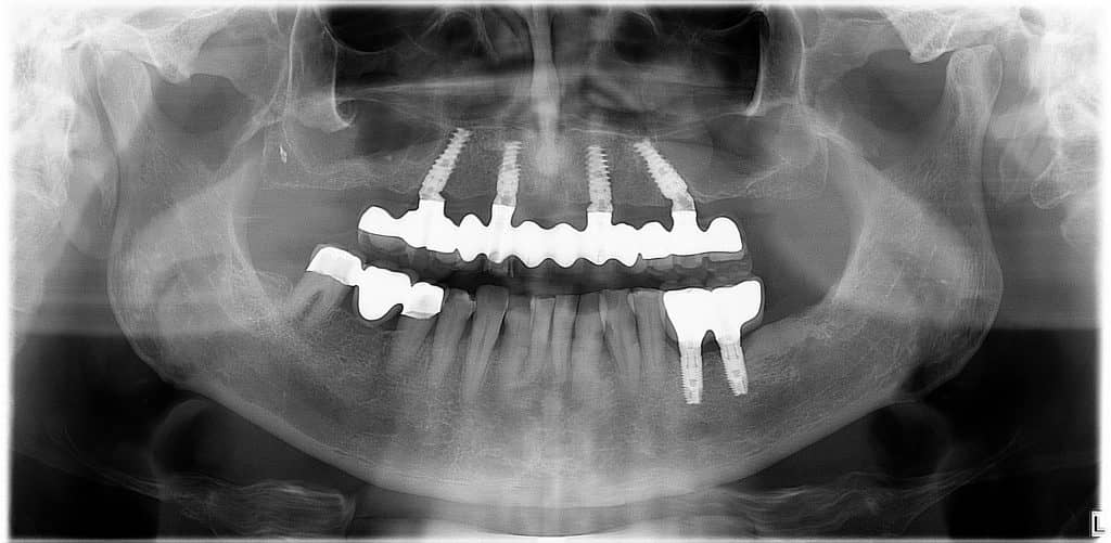 Prothese fixe all on 4 sur implants