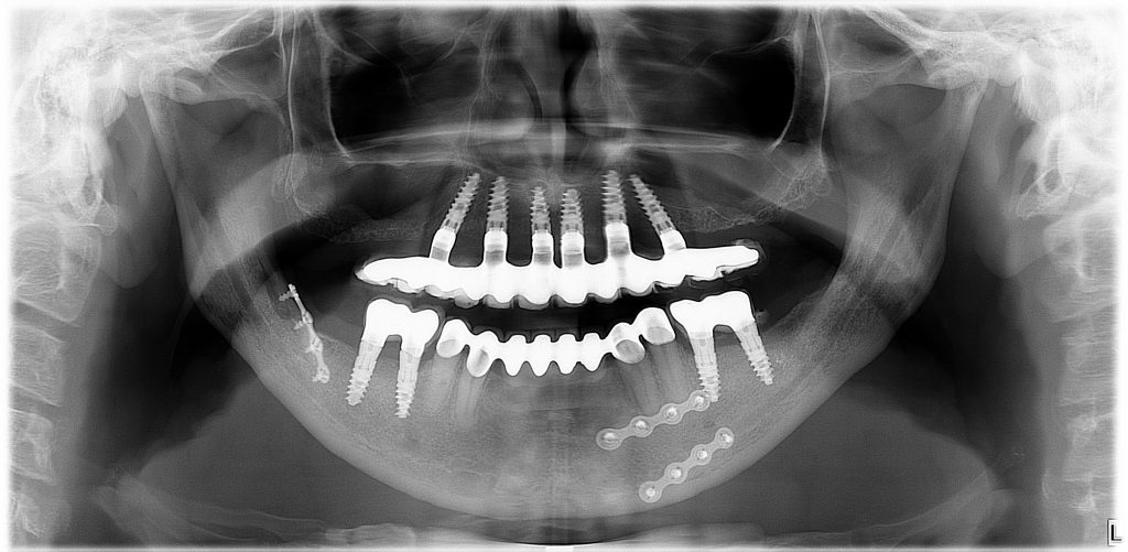 Prothese fixe sur implants all on 6