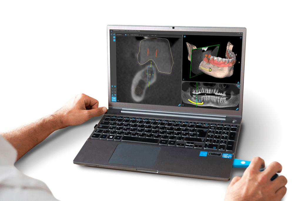 Smart guide implantation