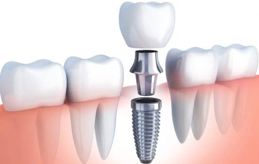 Implant Dentaire Hongrie Centre Dentaire Budapest