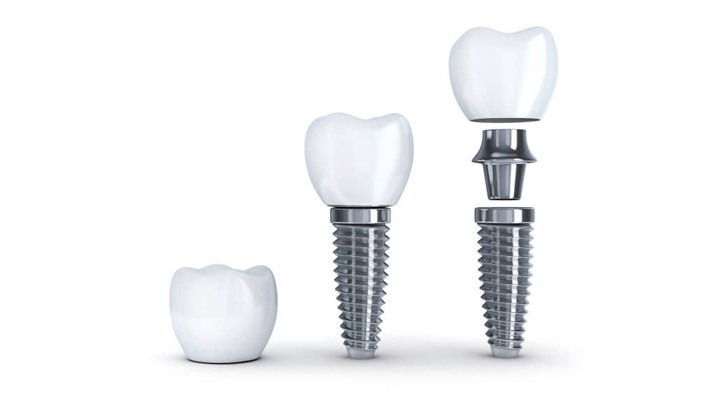 Implant dentaire hongrie clinique dentaire budapest