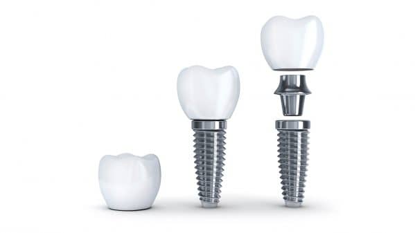 Implant Dentaire Hongrie Clinique Dentaire Budapest