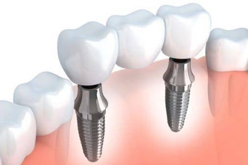 Implant Dentaire Hongrie Implant Bridge