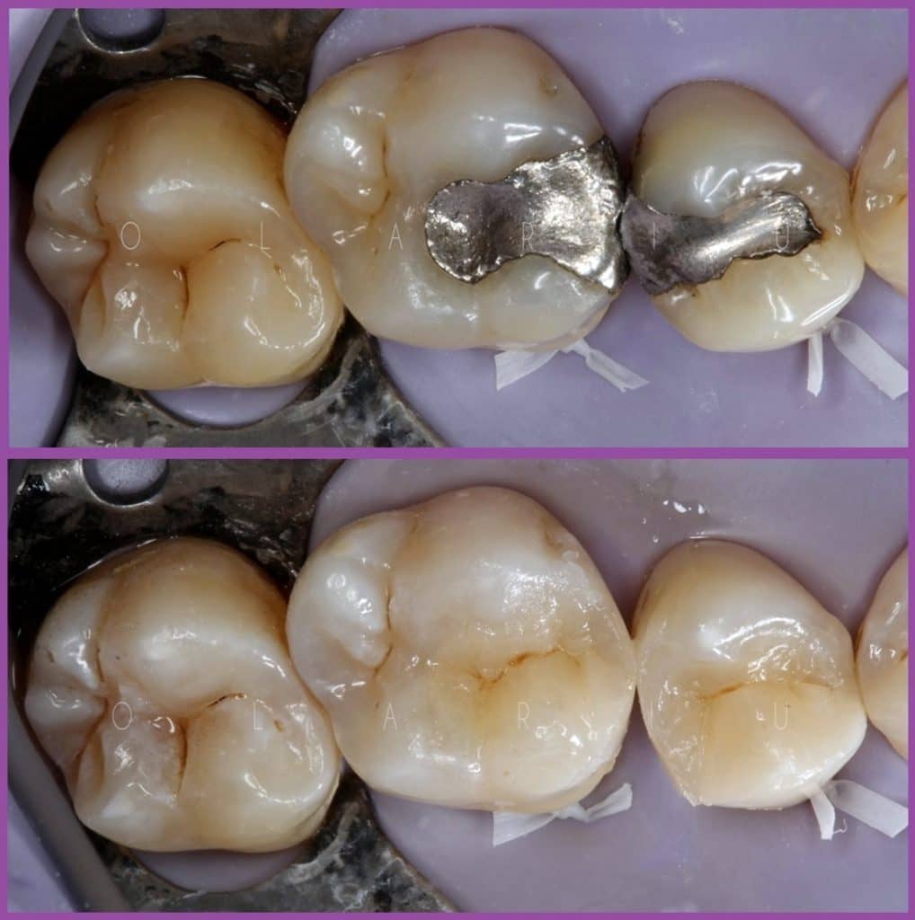 Soins composite plombage clinique dentaire hongrie